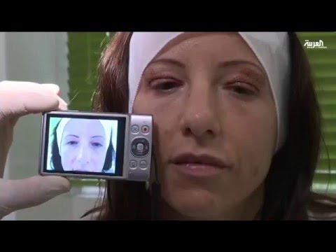 البلازما تقنية جديدة للتخلص من ترهل الجفون دون جراحة