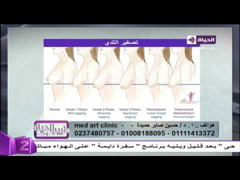 بالفيديو  مراحل ترهلات الثدي عند السيدات
