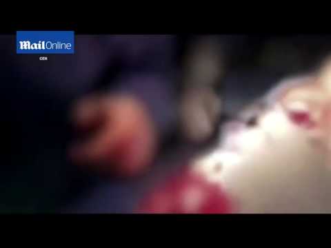 لحظة إزالة الأطباء قنبلة من رأس جندي