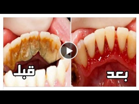 بالفيديو طريقة إزالة الرواسب البكتيرية من باطن أسنان الفم