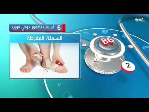تعرف على 6 أسباب لظهور دوالي الوريد