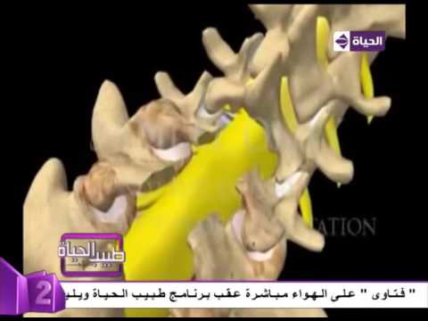 شاهد فيديو توضيحي لإجراء عملية في فقرات العمود الفقري