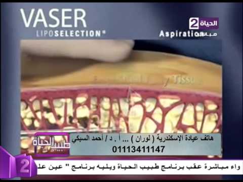 فيديو يوضح كيف يتم شفط الدهون بالفيزر