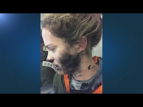 راكبة تصاب بحروق في الوجه بعد انفجار سماعاتها على متن طائرة