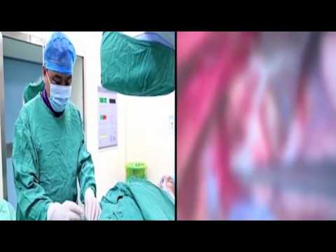 دودة شريطية تعيش في مخ مراهق لمدة عامين