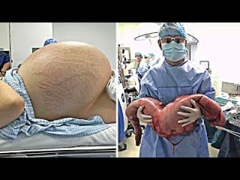 5 أشياء مستحيلة وجدها الأطباء داخل جسم الأنسان