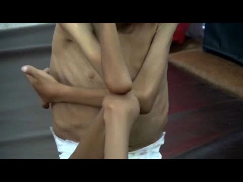 شاهد الأمم المتحدة تحذر من مجاعة تهدد الملايين ما لم تصل المساعدات إلى اليمن