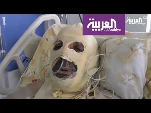 رياض خلف أب ولاجئ سوري أحرقه الفقر في لبنان