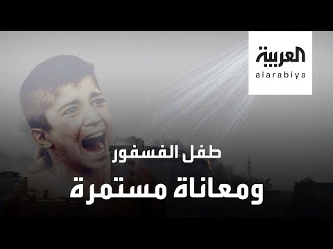 مأساة مستمرة لطفل الفوسفور المحترق بالقصف التركي