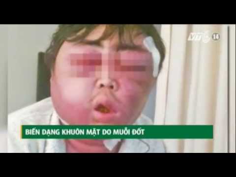 شاهد بعوضة تنفخ وجه رجل صيني كالبالون