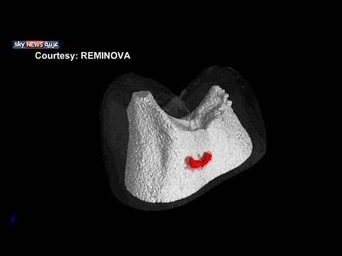 شاهد إعادة التمعدن لترميم الأسنان بسهولة