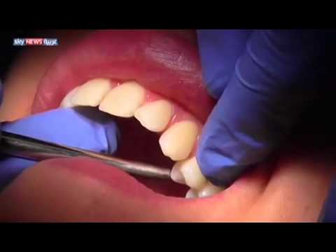 ابتكار جهاز يحفز الأسنان على ترميم نفسها