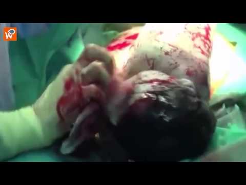 شاهد لحظة ولادة طفلة سورية أصيبت بشظايا في رحم أمها