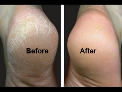 شاهد 3 حلول طبيعية للتخلص من تشقق القدمين