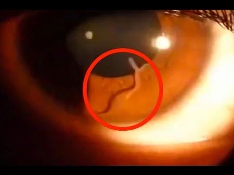 فيديو لحظة عثور طبيب على دودة حية