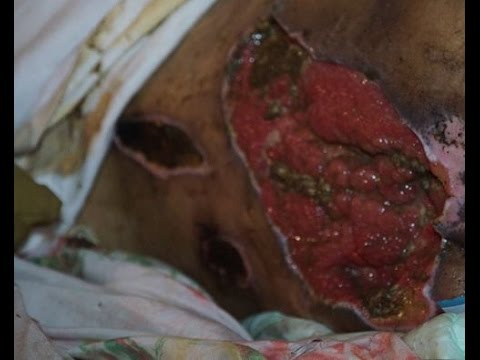 بالفيديو مغربي يتساقط جلده ويبكي ويستنجد بالضمائر الحية