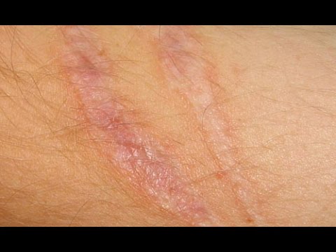 بالفيديو طريقة تخلصك من آثار الجروح نهائيا