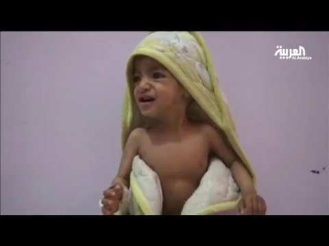 أطفال اليمن يدفعون ثمن الانقلاب