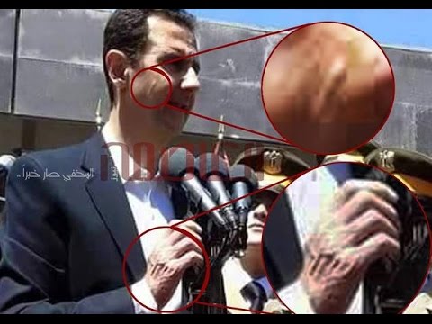 شاهد حقيقة المرض الغريب الذي ظهر على الرئيس بشار الأسد