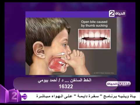 ما سبب تشوهات الأسنان عند الأطفال