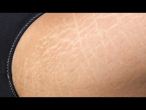 شاهد وصفة طبيعية لمنع تمدد و تشقق الجلد بعد الولادة